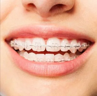 Ceramic braces fitted on upper and lower teeth at a dental clinic in Talwara