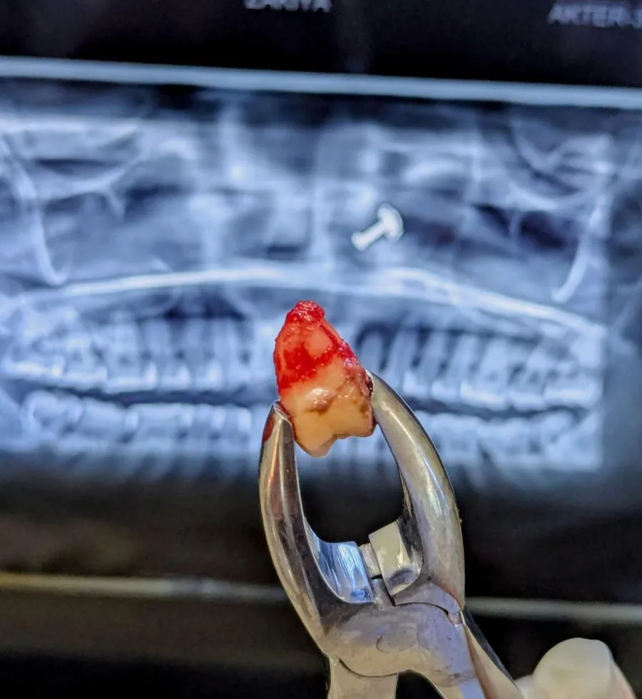 Extracted tooth held in forceps against a dental X-ray