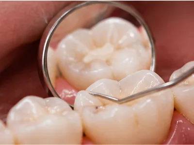 Dental mirror and explorer checking a molar for cavities