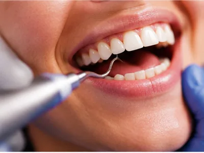 Professional scaling and cleaning of teeth