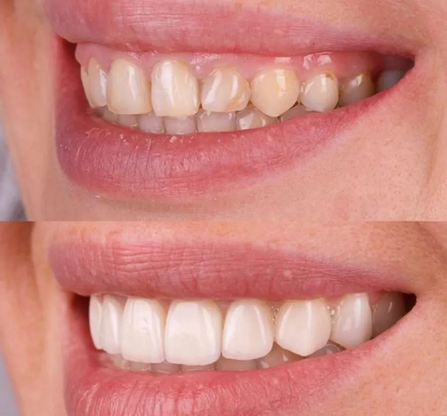 Before and after dental veneers on upper front teeth, Talwara