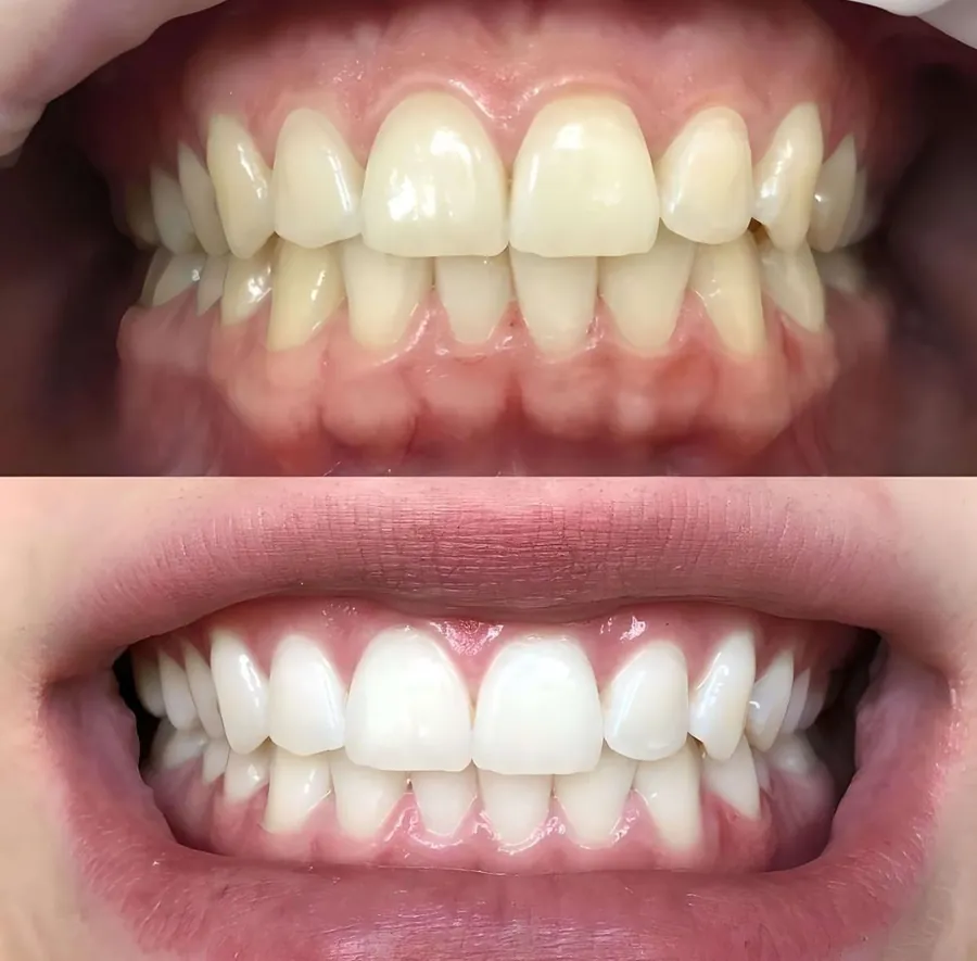 Before and after teeth whitening at 1st Choice Dental Clinic, Talwara